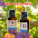 Get Rid of Ugly Varicose Veins!